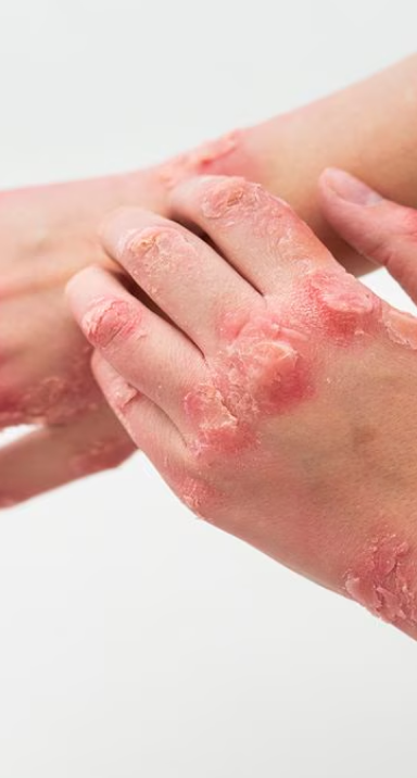 Impurities